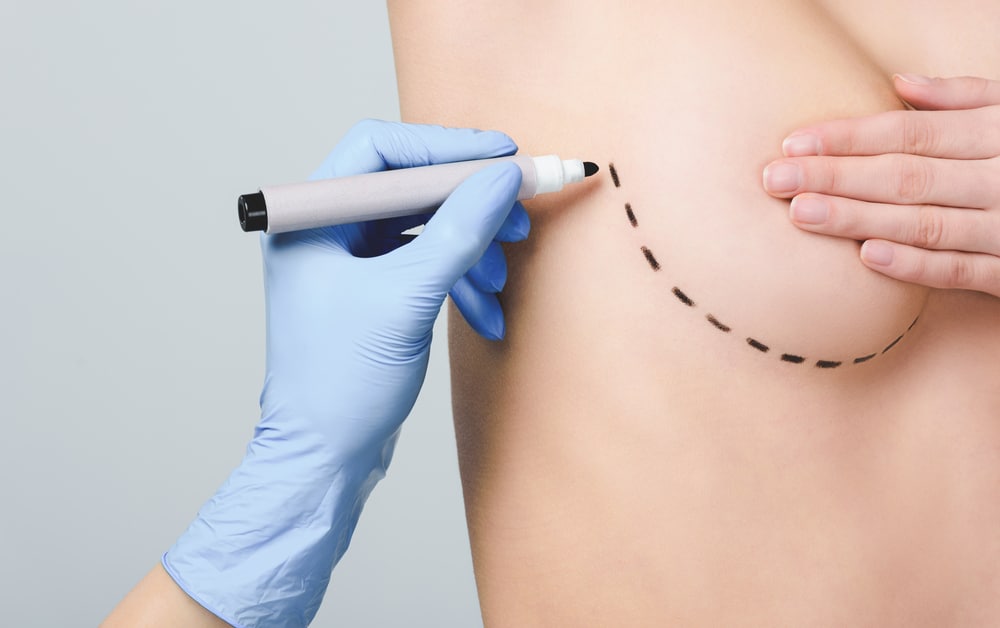 Brustvergrößerung mit Implantaten: Ihre Vorteile bei unserer Klinik in Bochum