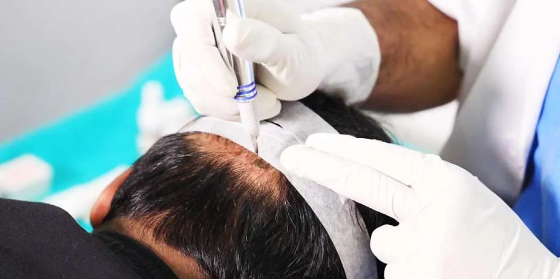 Natürlich aussehende Istanbul haartransplantation: Ihr Schlüssel zu Selbstvertrauen